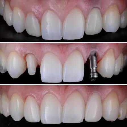 E-max dental crown on implant in the smile zone – enamel-like translucency at Santa Catarina, Porto - dental implants Porto UK patients
