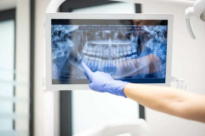 La radio panoramique 3D permet de mesurer l'os disponible et de confirmer votre éligibilité aux implants Straumann — à envoyer avant toute réservation.