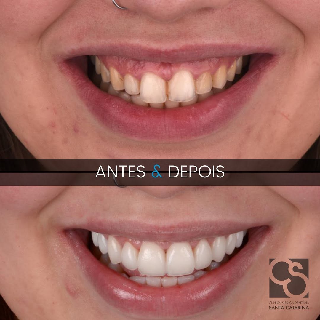 Smile aesthetics in Porto, Portugal – Crown lengthening and dental veneers