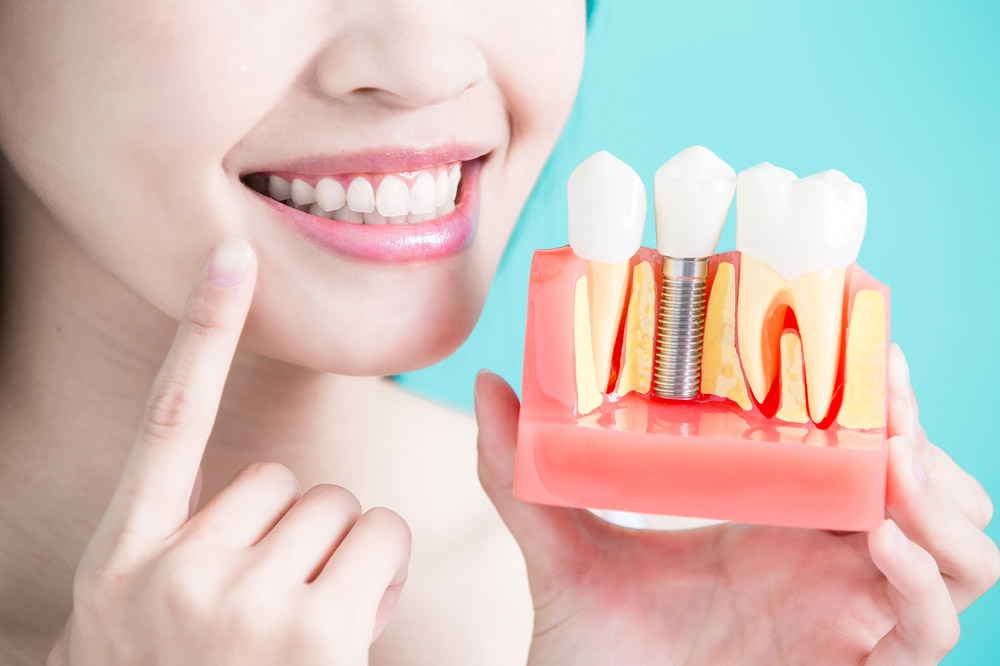 Sourire retrouvé après la pose d'implant - le résultat esthétique final à Porto