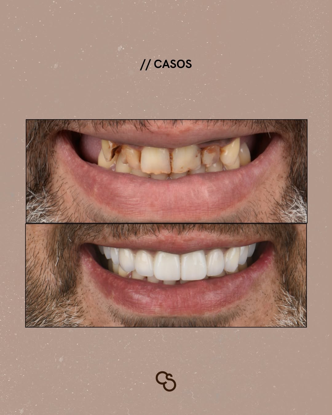 Your dental crown on implant journey in Porto – simple check-list before final crown - dental implants Porto UK patients