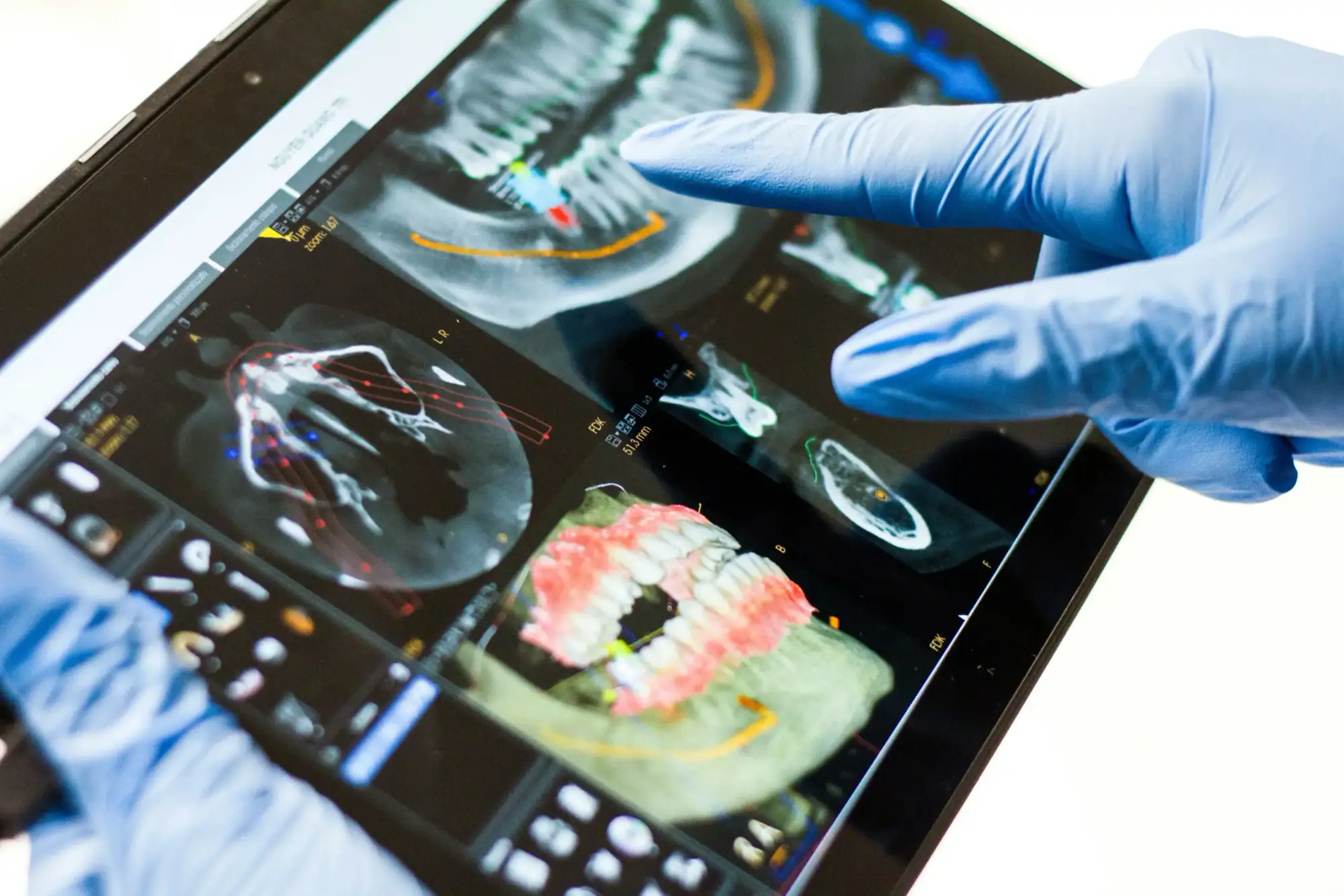 dental implants in Porto for Canadian patients – CBCT 3D planning in Porto clinic