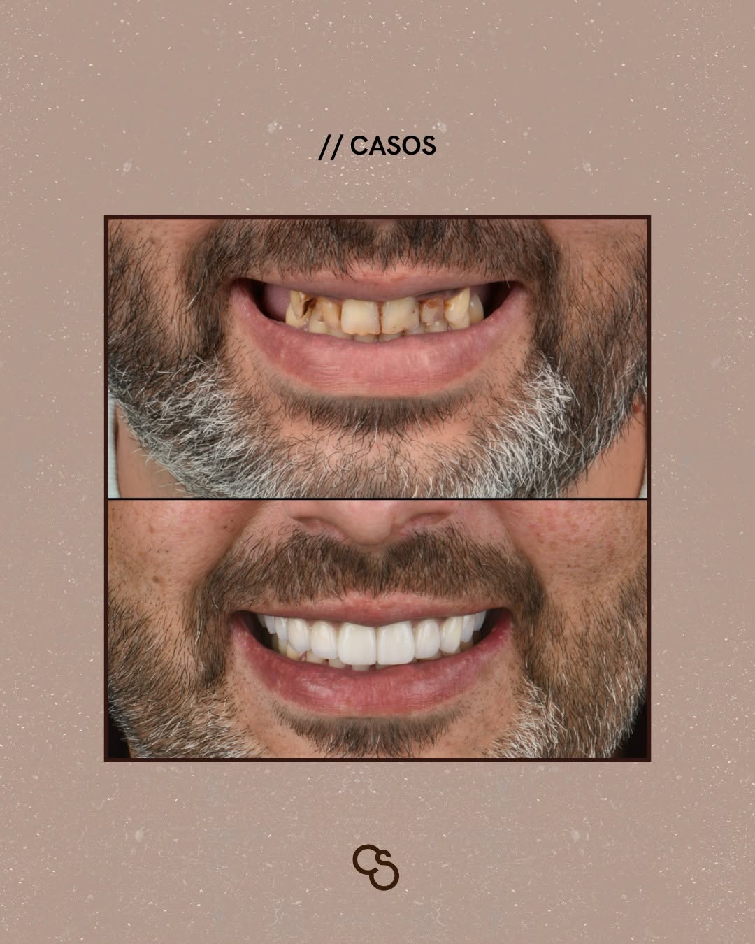 how dental tourism works for UK patients — natural smile after full arch implants in Porto 2026