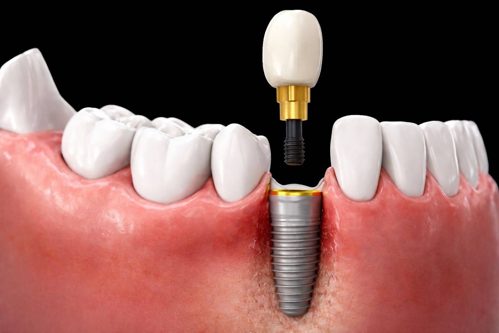 prix implant et couronne dentaire au portugal