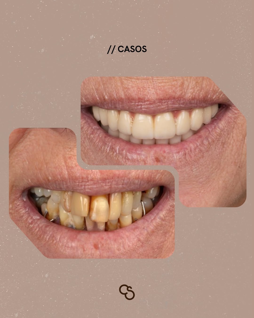 Before and after smile at Santa Catarina clinic: protecting the result with the right mouthwash after dental implant