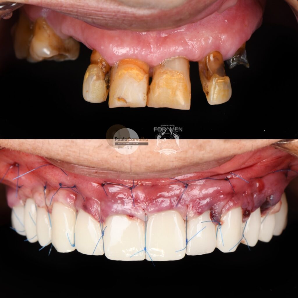 Prix All-on-4 mâchoire complète Portugal avant après de face - dents fixes en 1 chirurgie