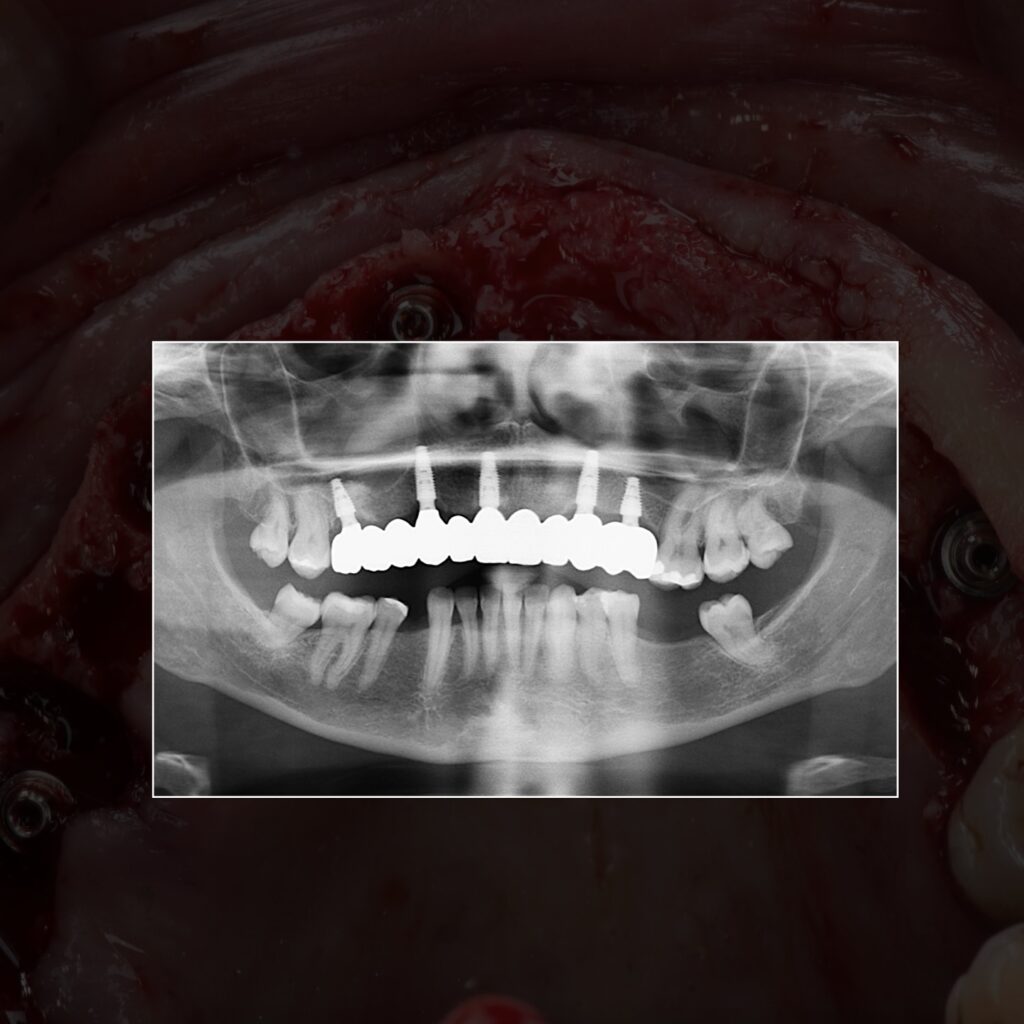 Radio All-on-4 mâchoire complète Portugal après 2 ans - implants ostéointégrés sous bridge zircone