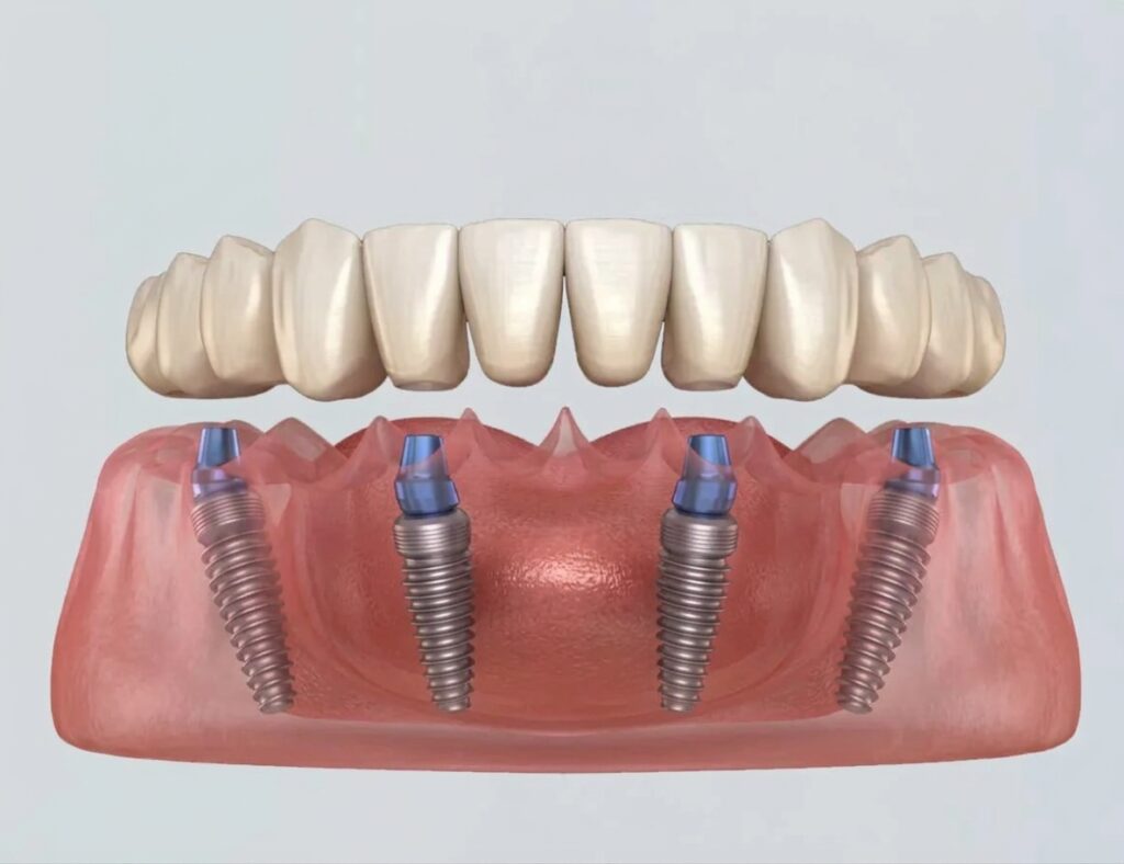 Réhabilitation All-on-4 sur 4 implants à Porto, Portugal