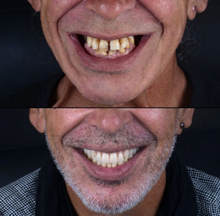 Résultat avant/après d’un All-on-4 au Portugal : dents fixes sur 4 implants
