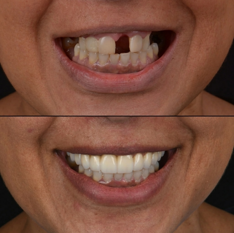 Remplacement d’une dent de devant par implant dentaire : avant/après à Porto