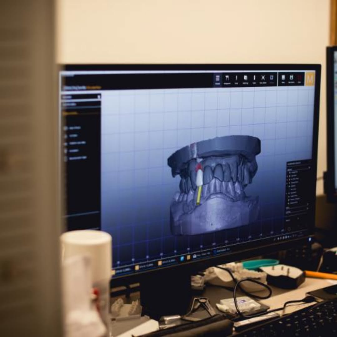 Empreinte optique et zircone sur mesure pour une couronne définitive sur implant au laboratoire de Porto
