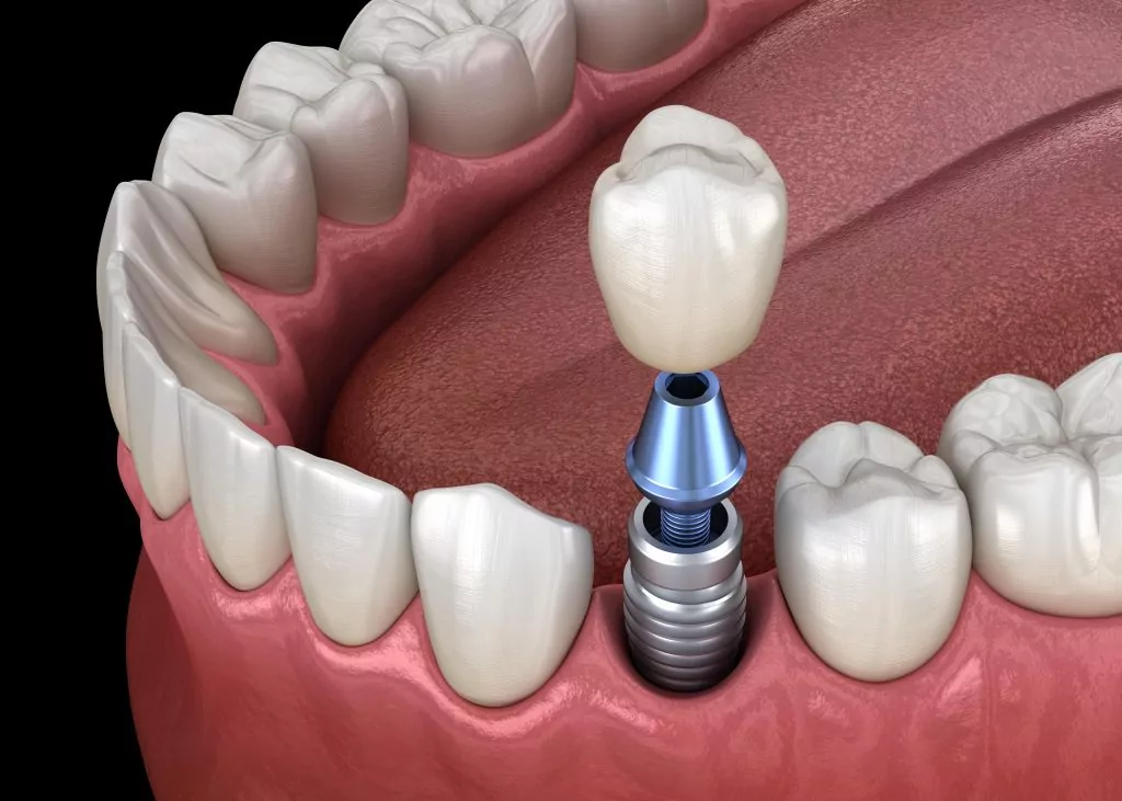 implant dentaire au Portugal